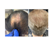 Your hair transplant and cost The Center For Cosmetic Surgery And The Washington Hair Institute With Dr. Steven B. Hopping in Washington in District of Columbia