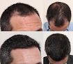 Your hair transplant and cost The Hair Loss Doctors in New York in New York