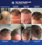 Your hair transplant and cost The Hair Transplant And Restoration Center in Dothan in AL
