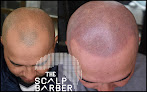 Your hair transplant and cost The Scalp Barber Scalp Micropigmentation Hair Loss Solution By Allure in Sacramento in California