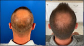 Your hair transplant and cost Tm Hair in Houston in Texas