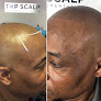 Your hair transplant and cost Top Scalp Micro / Hendersonville Smp Specialist in Hendersonville in North Carolina
