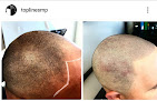 Your hair transplant and cost Topline Scalp Micropigmentation in Cherry Hill Township in New Jersey