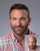 Your hair transplant and cost Tosi's Hair Restoration in Exeter in Pennsylvania