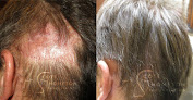Your hair transplant and cost Ufp Hair Restoration in Draper in Utah
