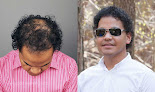 Your hair transplant and cost Van Scoy Hair Clinic - Columbus in Columbus in Ohio
