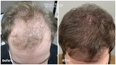 Your hair transplant and cost Van Scoy Hair Clinic in Parma in Ohio