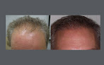 Your hair transplant and cost Virginia Hair Transplant in Leesburg in Virginia