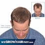 Your hair transplant and cost We Grow Hair Indy | Pai Medical Group in Indianapolis in IN