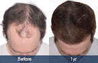 Your hair transplant and cost We Grow Hair / Nashville Medical Group in Brentwood in TN