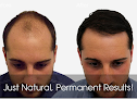 Your hair transplant and cost Ziering Medical Hair Restoration Beverly Hills in West Hollywood in California
