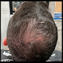 Your hair transplant and cost Ziering Medical Hair Restoration Connecticut in Greenwich in Connecticut