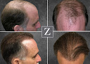 Your hair transplant and cost Ziering Medical New York in New York in New York
