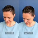 Hair Transplant Clinics in Aberdeen, South Dakota