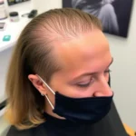 Hair Transplant Clinics in Atlanta, Cobb