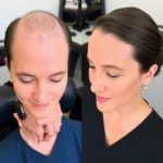 Hair Transplant Clinics in Beverly Hills, California