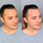 Hair Transplant Clinics in Burbank, California