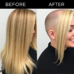 Hair Transplant Clinics in Charlotte, Carolina del Norte