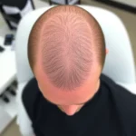 Hair Transplant Clinics in Clifton Heights, Pennsylvania