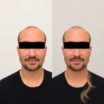 Hair Transplant Clinics in Concord, California