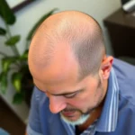 Hair Transplant Clinics in Dallas, Texas