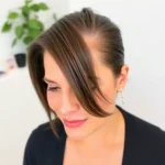 Hair Transplant Clinics in Danville, Contra Costa