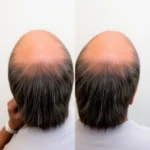 Hair Transplant Clinics in Deerfield, Illinois