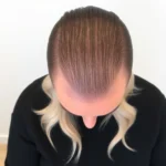 Hair Transplant Clinics in Dublin, OH