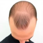 Hair Transplant Clinics in Farmington Hills, MI