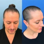 Hair Transplant Clinics in Florence, KY
