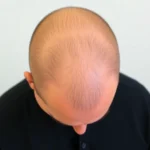 Hair Transplant Clinics in Fort Myers, FL