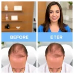 Hair Transplant Clinics in Gahanna, OH