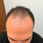Hair Transplant Clinics in Granite Bay, Placer
