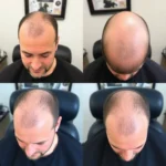 Hair Transplant Clinics in Greensboro, Carolina del Norte
