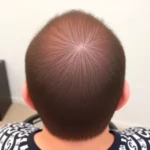 Hair Transplant Clinics in Jeffersontown, KY