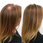 Hair Transplant Clinics in Maitland, Orange