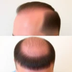 Hair Transplant Clinics in Memphis, Tennessee