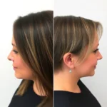 Hair Transplant Clinics in Merrillville, Indiana