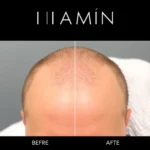 Hair Transplant Clinics in Newton, MA