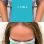 Hair Transplant Clinics in Nicholasville, KY