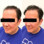 Hair Transplant Clinics in Olympia Fields, Illinois