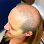 Hair Transplant Clinics in Roseville, Placer