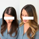 Hair Transplant Clinics in Salt Lake City, Utah