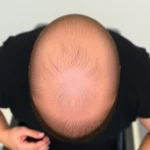 Hair Transplant Clinics in Thornton, Colorado