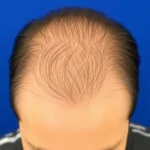 Hair Transplant Clinics in Torrance, California