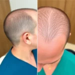 Hair Transplant Clinics in Tucson, AZ