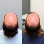 Hair Transplant Clinics in Wilmington, DE
