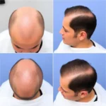 Best Hair Transplant Clinics In Columbia, Maryland