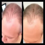 Best Hair Transplant Clinics In Cranbury, New Jersey