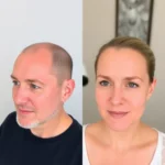 Best Hair Transplant Clinics In Danville, California